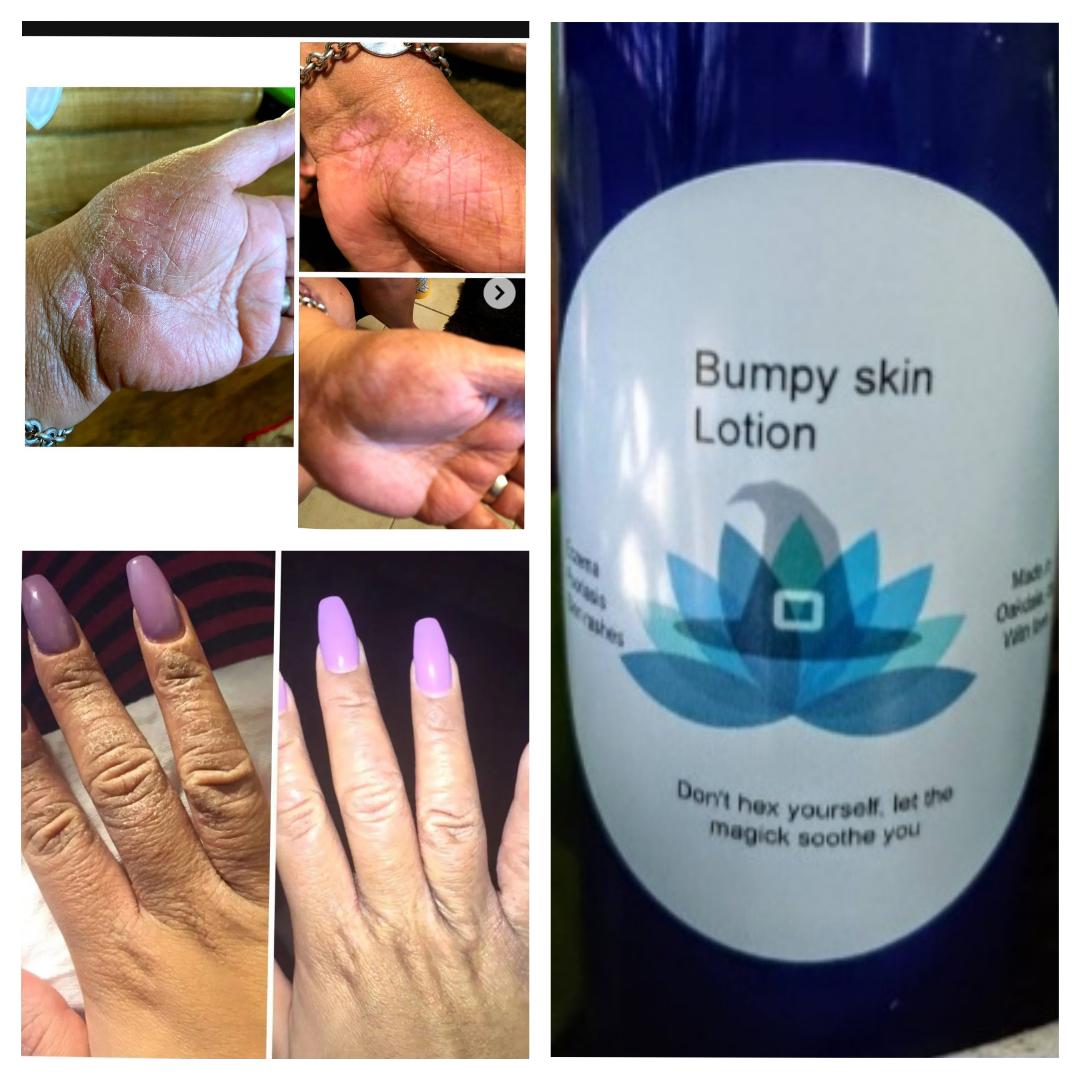 Eczema/rash lotion