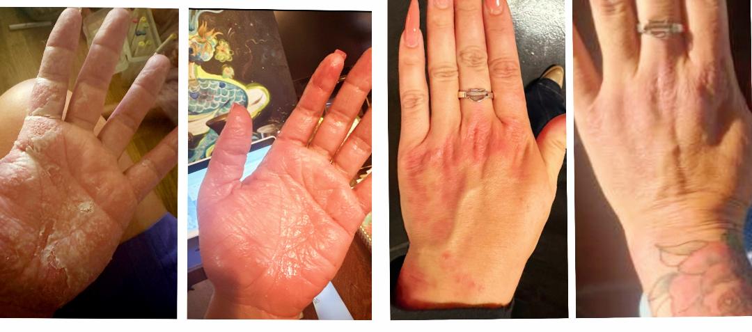 Eczema/rash lotion